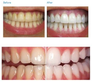 teeth whitening glasgow examples